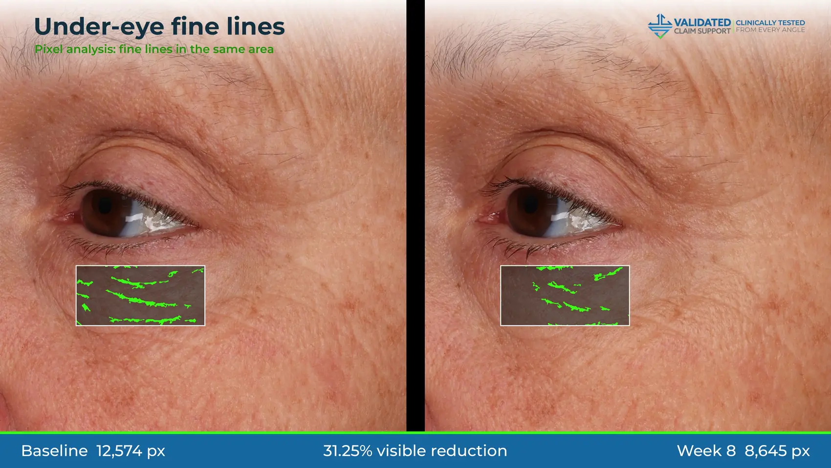 Deck-style graphic: under-eye fine lines, 31.25% visible reduction