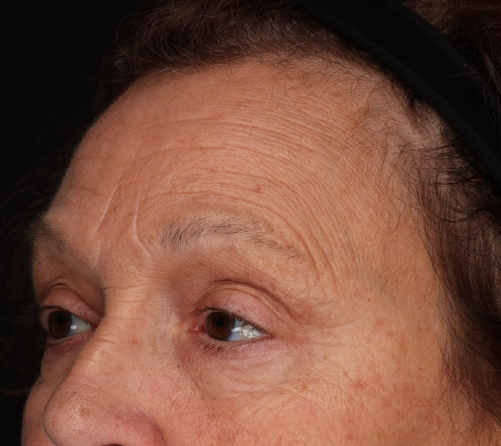 Quarter face, nose up, under-eye fine lines at week 8