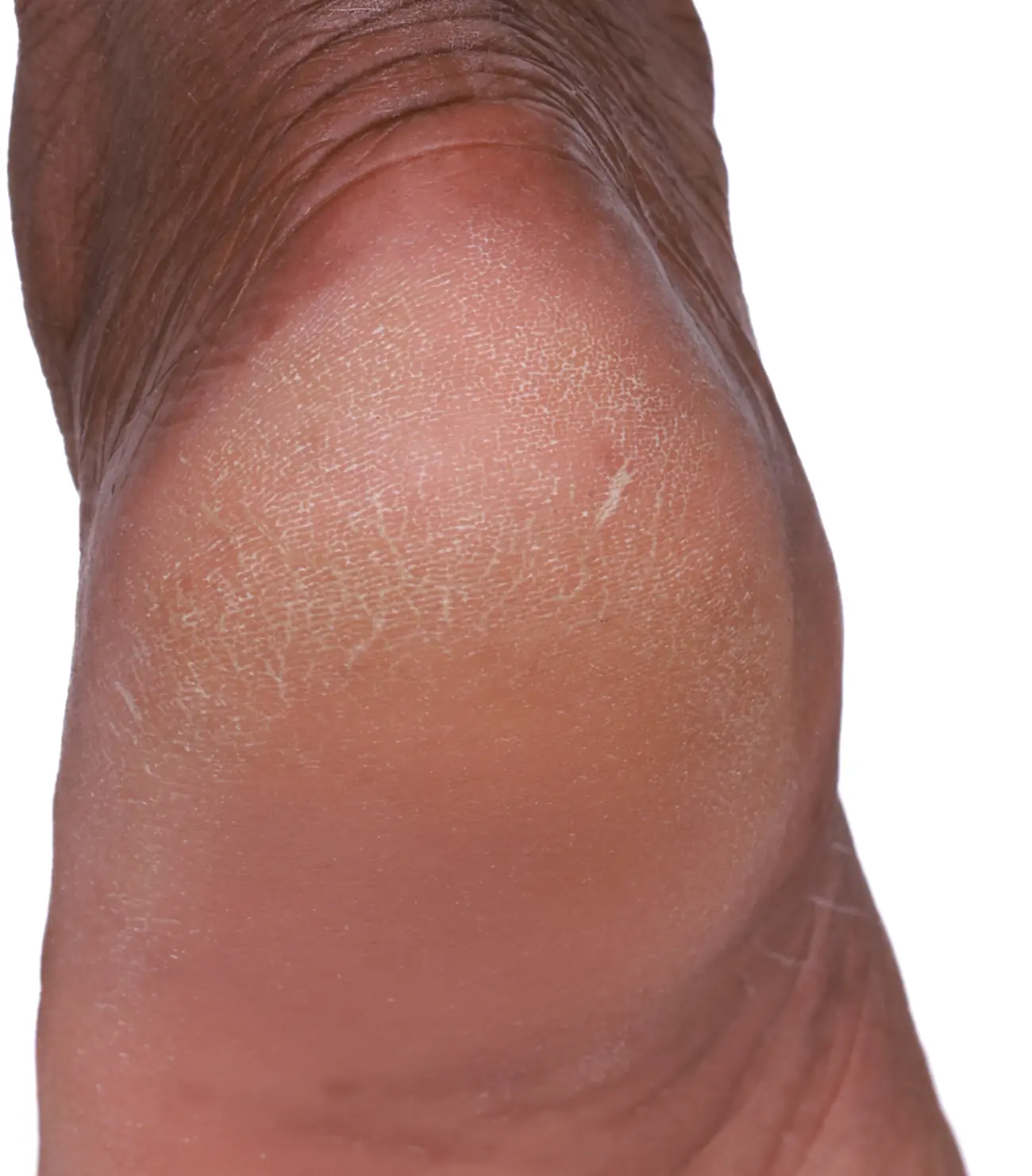 Cracked heel, darker skin tone, after treatment, with fewer flakes