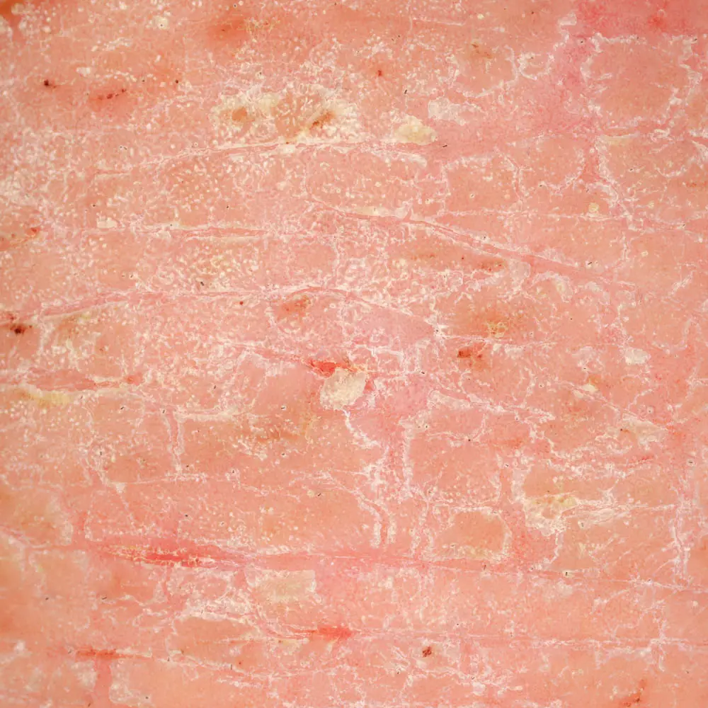 Close-up of eczema at baseline