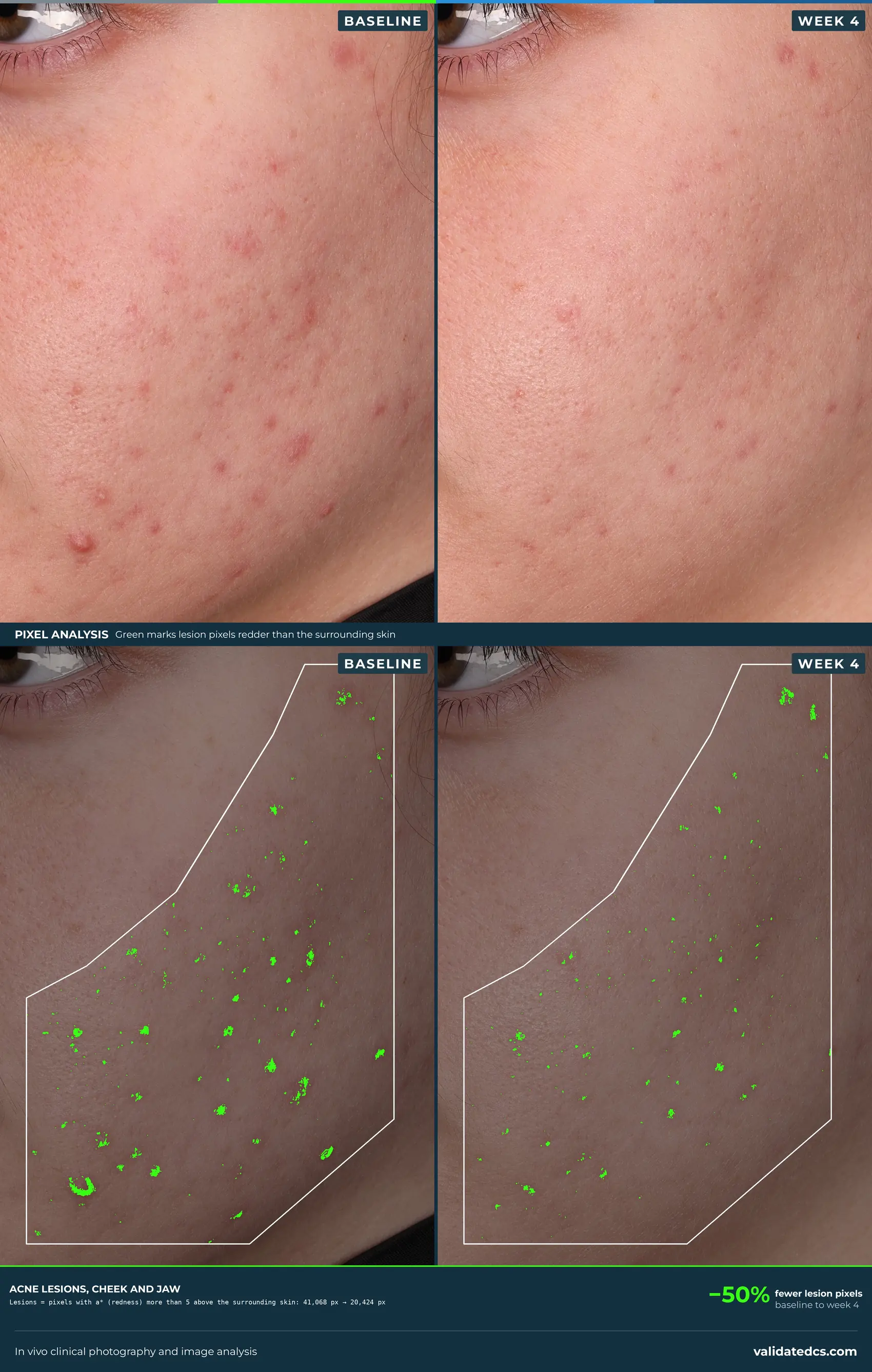 Case study graphic: acne lesions, 50% fewer lesion pixels from baseline to week 4