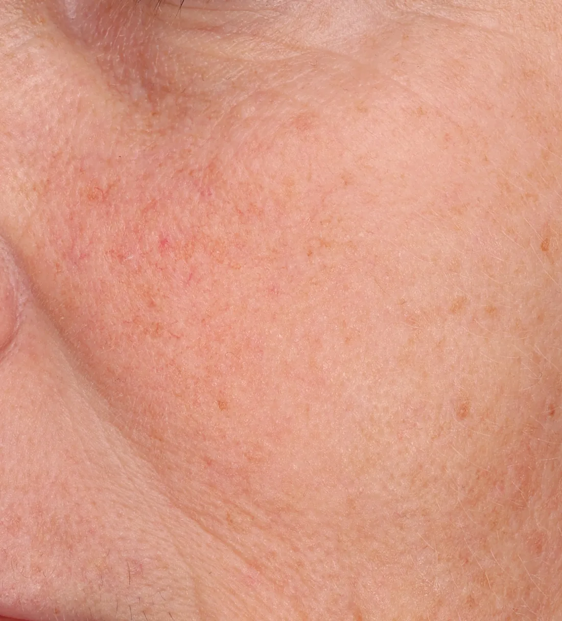 Cheek close-up at week 2, with less redness