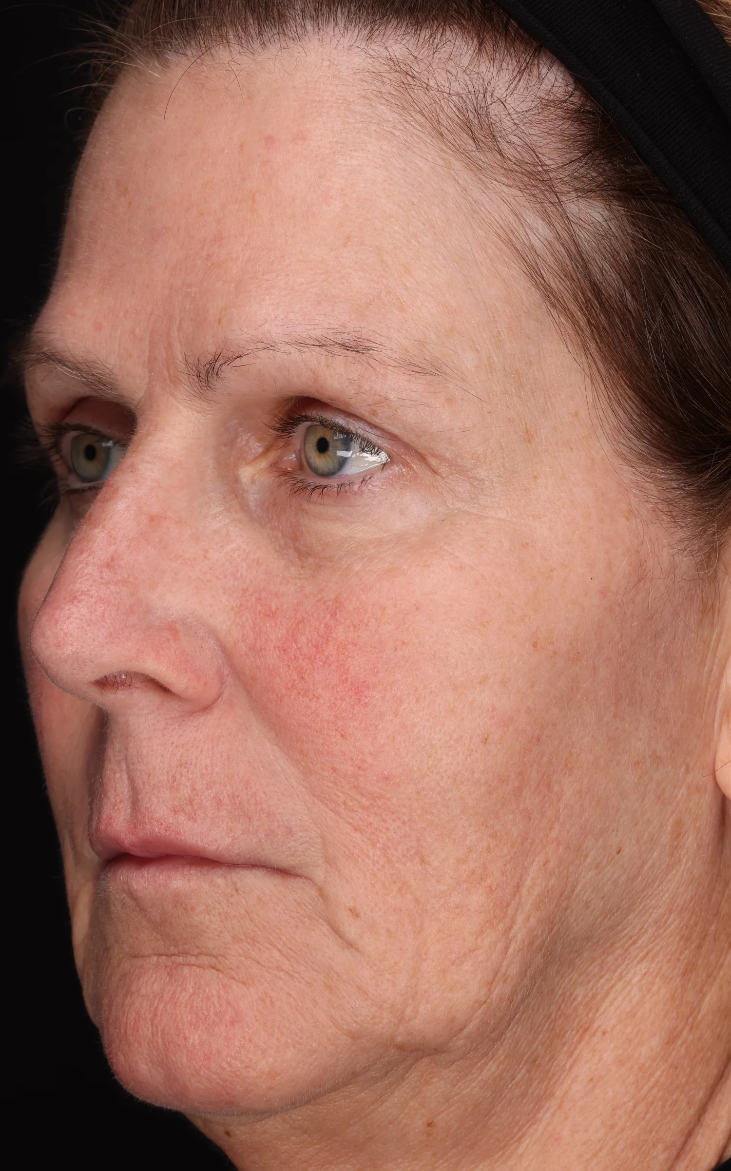 Full face with cheek redness at baseline