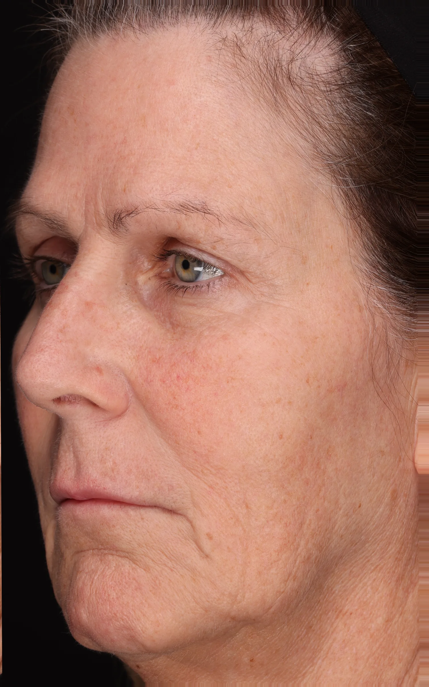 Full face at week 2, with less cheek redness