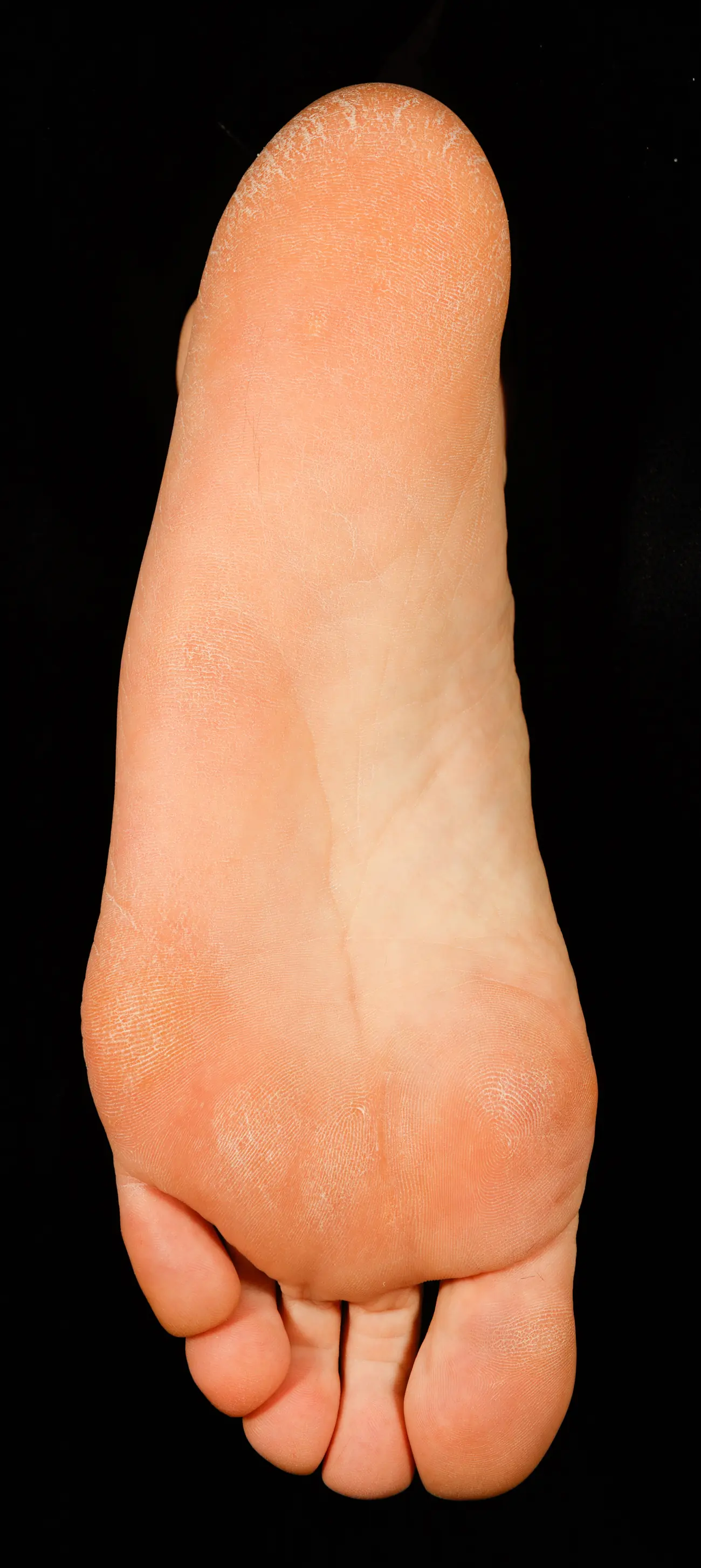Sole of the foot with dry skin at baseline