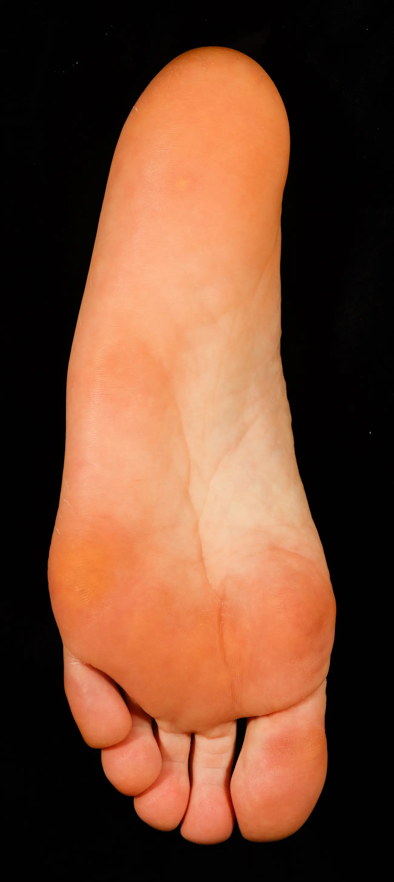 Sole of the foot immediately after treatment, with less dry skin