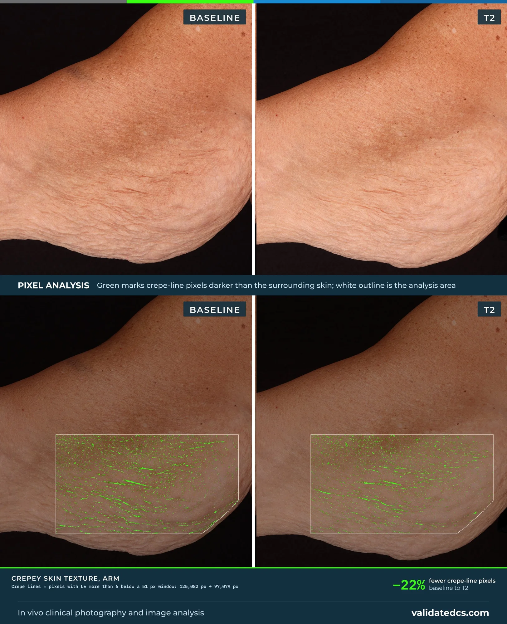 Case study graphic, Crepey skin texture, arm: −22% fewer crepe-line pixels, baseline to T2, print layout with pixel analysis