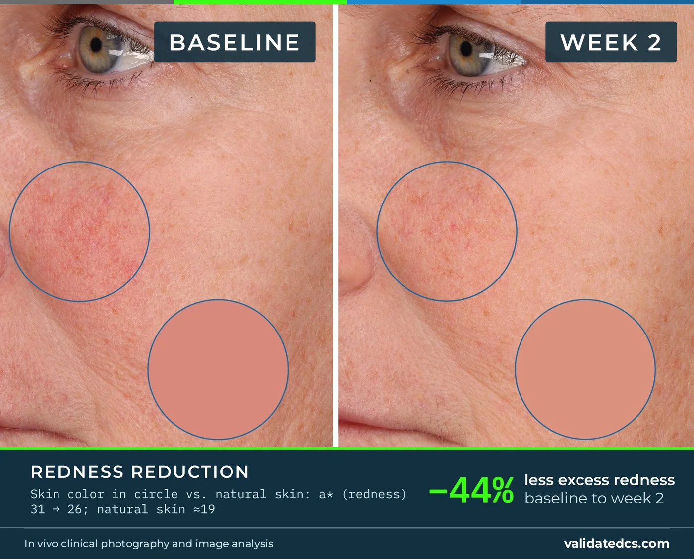 Case study graphic, Redness reduction, cheek: −44% less excess redness, baseline to week 2, color swatch layout