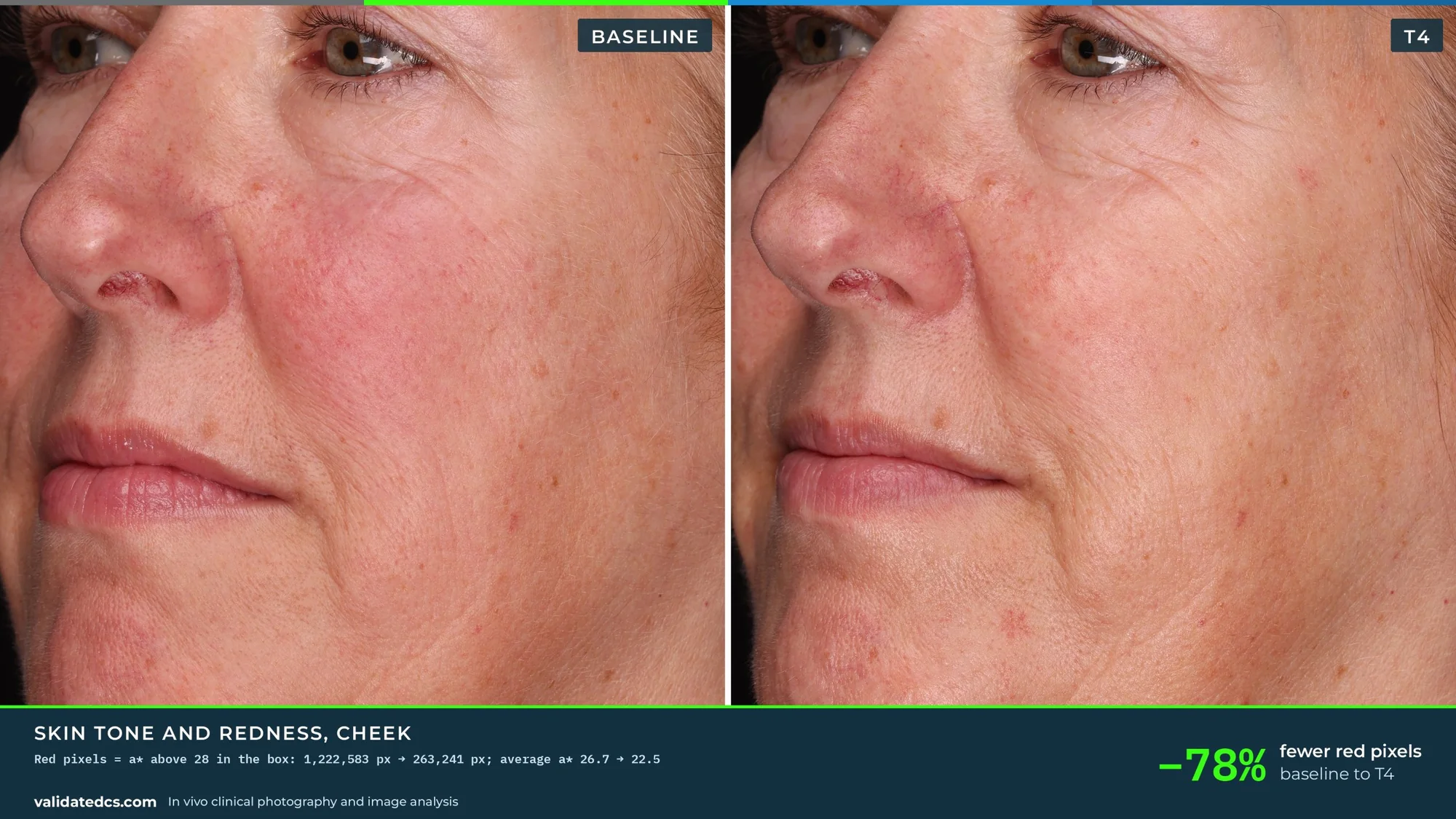 Case study graphic, Skin tone and redness, cheek: −78% fewer red pixels, baseline to T4, 16:9 screen layout