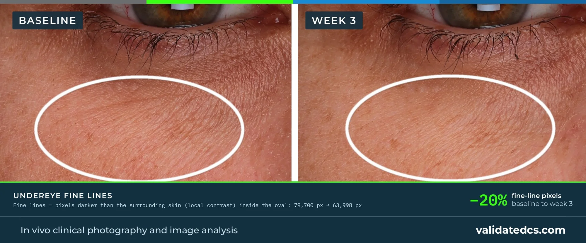 Case study graphic, Under-eye fine lines: −20% fine-line pixels, baseline to week 3, photos only